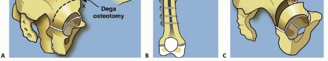 Illustration 28 for Treatment for Congenital Femoral Deficiency: What You Need to Know