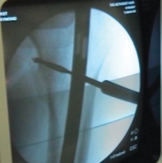 Illustration 21 for Arthrodesis with an Intramedullary Nail: Fixing Failed TKAs