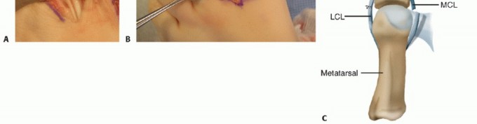 Illustration 5 for Toe Deformity Pain? Rebalance Flexor to Extensor for Relief