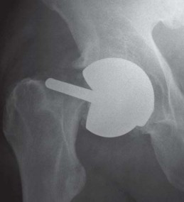 Illustration 2 for Minimizing Risks: Computer Navigation in Hip Resurfacing Arthroplasty