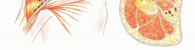 Illustration 6 for Mastering Total Scapular Resections: Reconstruction & Outcomes