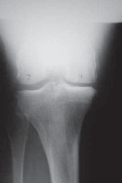 Illustration 15 for Guide Pin Assembly: Key to Flawless Upper Tibial Osteotomy