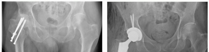 Illustration 9 for PJI of the Hip: Two-Stage Revision: When & How to Prepare