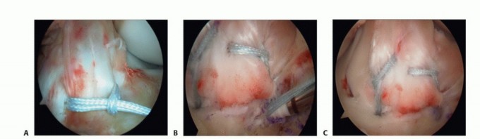 Illustration 18 for Treating Tibial Spine Fractures: Arthroscopy or Open Reduction?