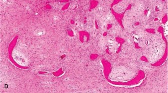 Illustration 7 for Diagnostic Dilemma: Unpacking Oncology Cases Enchondroma