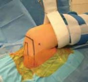 Illustration 12 for Regain Stability: Anterior Shoulder Instability Arthroscopic Fix