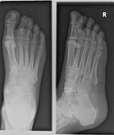 Ace the Enchondroma Examination Question: Diagnosis & Management