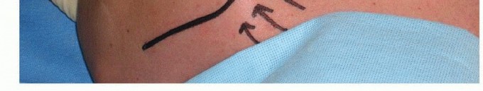 Illustration 23 for Is Your Dorsal Scapular Nerve Causing Snapping Scapula Pain?