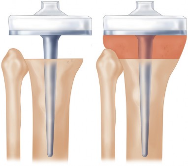 Illustration 7 for Structural Allografting Figure Guide: Solutions for Bone Deficiency