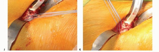 Illustration 34 for Anterior FAI Relief: Mini-Open Anterior Approach Explained