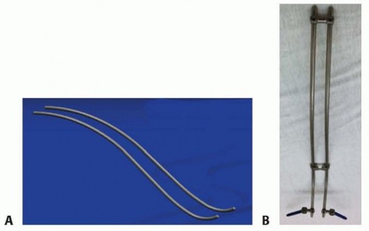 Illustration 7 for Duchenne Muscular Dystrophy: Is Spinal Fusion the Answer?