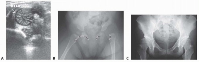 Illustration 6 for Mastering Anterior Open Reduction for Developmentally Dislocated Hip