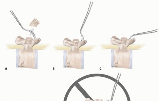 Illustration 17 for Duchenne Muscular Dystrophy: Is Spinal Fusion the Answer?