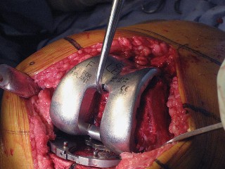 Illustration 46 for Posterior Stabilized Technique: Essential Insights for TKA Success