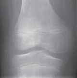 Conquer Discoid Lateral Meniscus Pain with Meniscoplasty