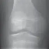 صورة توضيحية لـ الغضروف الهلالي القرصي في الركبة: دليل شامل للمرضى في اليمن والخليج مع الأستاذ الدكتور محمد هطيف