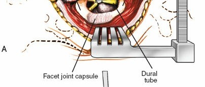 Illustration 22 for Mastering the Spine Posterior Approach: Surgical Essentials