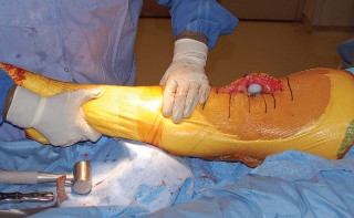 Illustration 44 for Mastering Gap Balancing in Revision TKA: Avoid Common Pitfalls