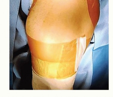 Illustration 13 for Restore Hip Health: Pelvic Osteotomy for Acetabular Dysplasia & CEA of Less