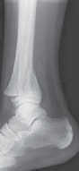 Illustration 5 for Pediatric Ankle Fractures: Management to Prevent Long-Term Issues