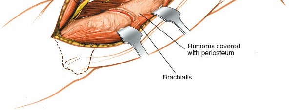 Illustration 68 for Mastering the Approach to the Distal Humerus: Safety & Skills