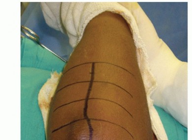 Illustration 31 for Radial Head & Neck Fractures: Mastering ORIF for Best Results