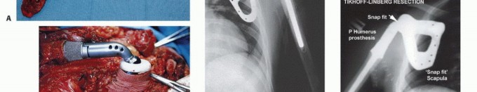 Illustration 24 for Distal Femoral Replacement: Key to Modern Limb Salvage