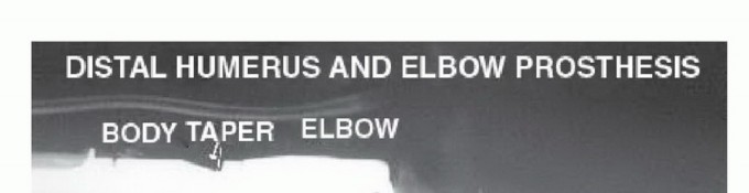 Illustration 28 for Distal Humeral Resection: Safe Techniques for Limb Preservation