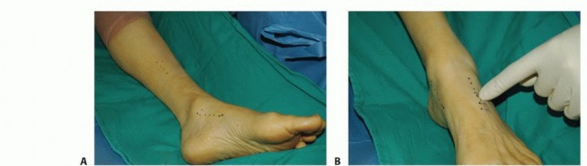 Illustration 24 for Foot Drop Surgery: How a Pin or Drill Elevates Tendon Transfer