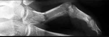 صورة طبية: دليل الأستاذ الدكتور محمد هطيف الشامل لأمراض وإصابات اليد والمعصم في صنعاء