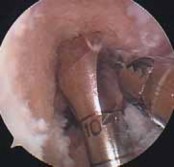 Illustration 67 for Optimizing Single-Bundle Anterior Cruciate Ligament Repair