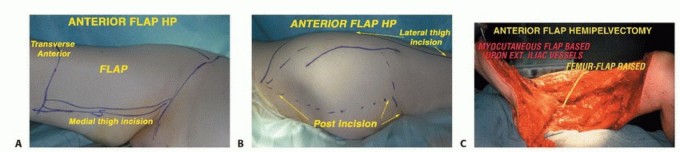 Illustration 6 for Anterior Flap Hemipelvectomy: Leveraging fig tech fig for Difficult Tumors