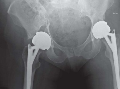Illustration 43 for Management of Periprosthetic Fractures: An Expert Surgical Guide