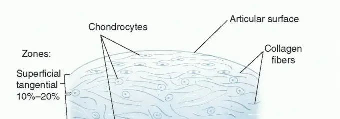 ترقيع الغضروف العظمي الذاتي: استعادة المفاصل والحياة بلا ألم مع الأستاذ الدكتور محمد هطيف