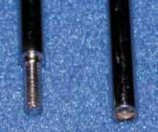 Illustration 9 for Solving Congenital Pseudarthrosis: Tibia with the Williams Rod