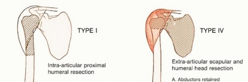 Illustration 6 for Limb-Sparing Resections Around the Shoulder: Optimizing Outcomes