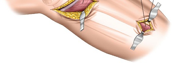 Illustration 52 for Surgical Access: Mastering the Tibia's Surface & Fibula Approaches