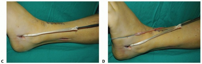 Illustration 43 for Restore Movement: Tendon Transfer for Common Peroneal Nerve Foot Drop