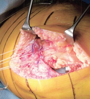 Illustration 22 for Minimally Invasive Subvastus: The Best Path to Quicker TKA Recovery