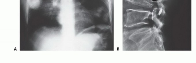 Illustration 23 for Precision Biopsy of Musculoskeletal Tumors for Accurate Diagnosis