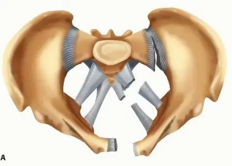 صورة توضيحية لـ التثبيت الخارجي للحوض: دليل شامل للمرضى في اليمن والخليج العربي نحو الشفاء