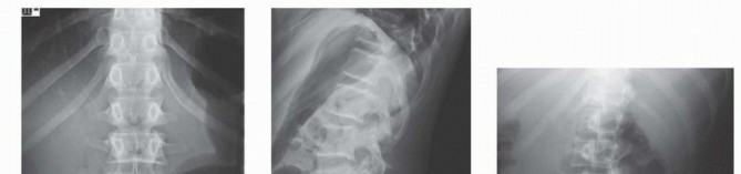 Illustration 5 for Mastering High-Grade Spondylolisthesis: Posterolateral and Interbody Fusion