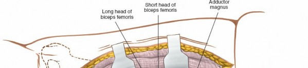 Illustration 40 for Optimal Femoral Approaches: Mastering the Lateral Intermuscular Septum