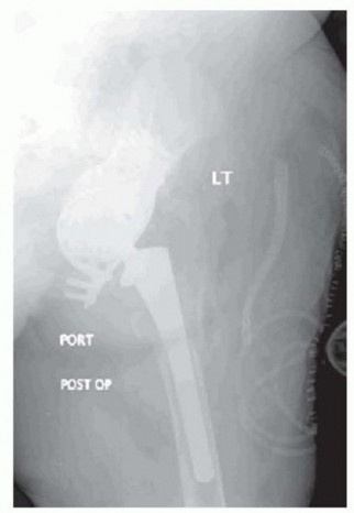 Illustration 21 for Revision Arthroplasty with Acetabular Bone Loss: The Antiprotrusio Cage