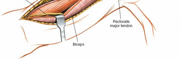 Illustration 12 for Humeral Shaft Anterior Approach: Master Surgical Techniques