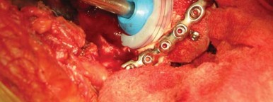 Illustration 32 for Navigating Early THA for Fractures of the Acetabulum