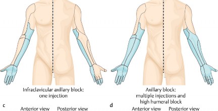 Illustration of shoulder surgery perioperative - Dr. Mohammed Hutaif