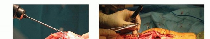 Illustration 5 for Patella Tendon Rupture Reconstruction in Revision TKA