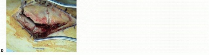 Illustration 14 for Fixation of Lisfranc Injuries: Essential Open Reduction Guide