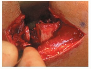 Illustration 2 for Solving Infantile Blount Disease: Surgical Management Strategies